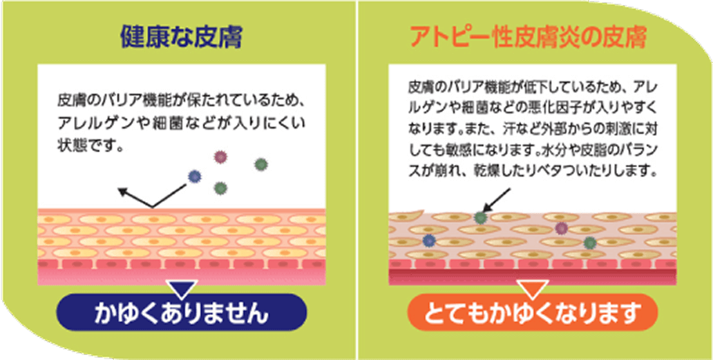健康な皮膚 / アトピー性皮膚炎の皮膚
